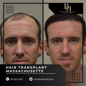 Top Hair Transplant Clinics in Massachusetts for your Hair Loss Problem